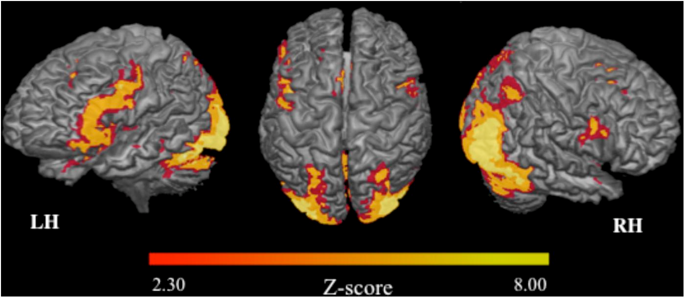 Attivazione cerebrale in un task di memoria rilevata tramite imaging di Risonanza Magnetica funzionale (fMRI) [Sharon S. Simon et al, «Cognitive and Brain Activity Changes After Mnemonic Strategy Training in Amnestic Mild Cognitive Impairment: Evidence From a Randomized Controlled Trial», Frontiers in Aging Neuroscience, 2018]