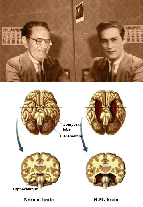 H.M. e il suo stato cognitivo: non riuscendo a immagazzinare nuovi ricordi, il paziente ricordava di avere 27 anni anche quando ormai era trascorso molto tempo dall'operazione. Di fatto, verso la fine della propria vita era come &ldquo;un giovane nel corpo di un anziano&rdquo;. In basso si pu&ograve; vedere un&rsquo;illustrazione del cervello di H.M. confrontato con quello di una persona sana.
